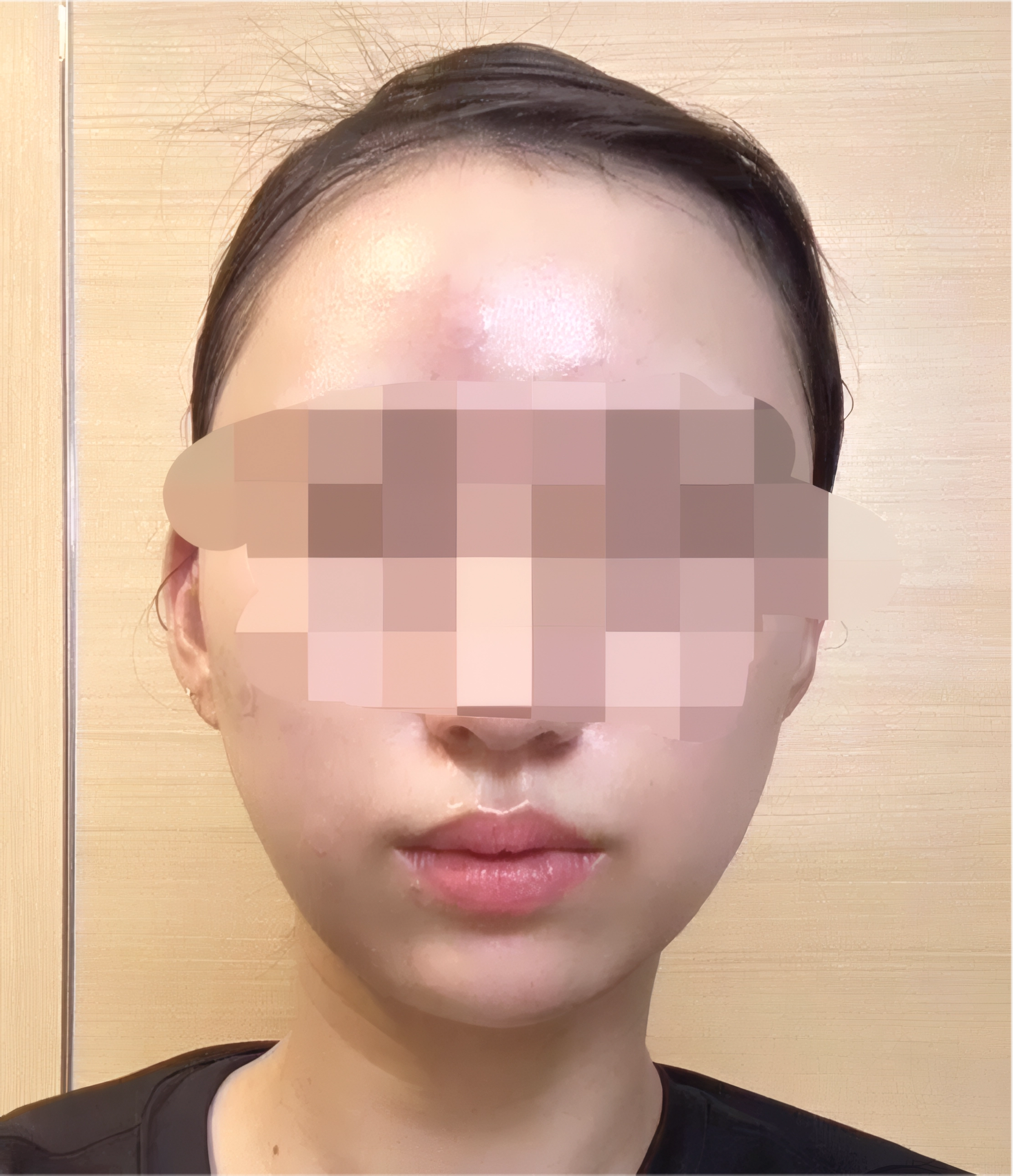 フェイスライン AFTER 30代女性